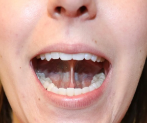 Top view of the upper dental arch showing a palatal expansion device attached to the molars with a central screw mechanism