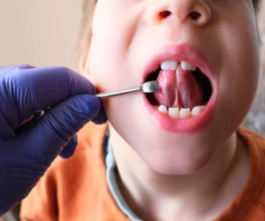 Top view of the upper dental arch showing a palatal expander attached to the molars with wires and screws used to widen the palate.