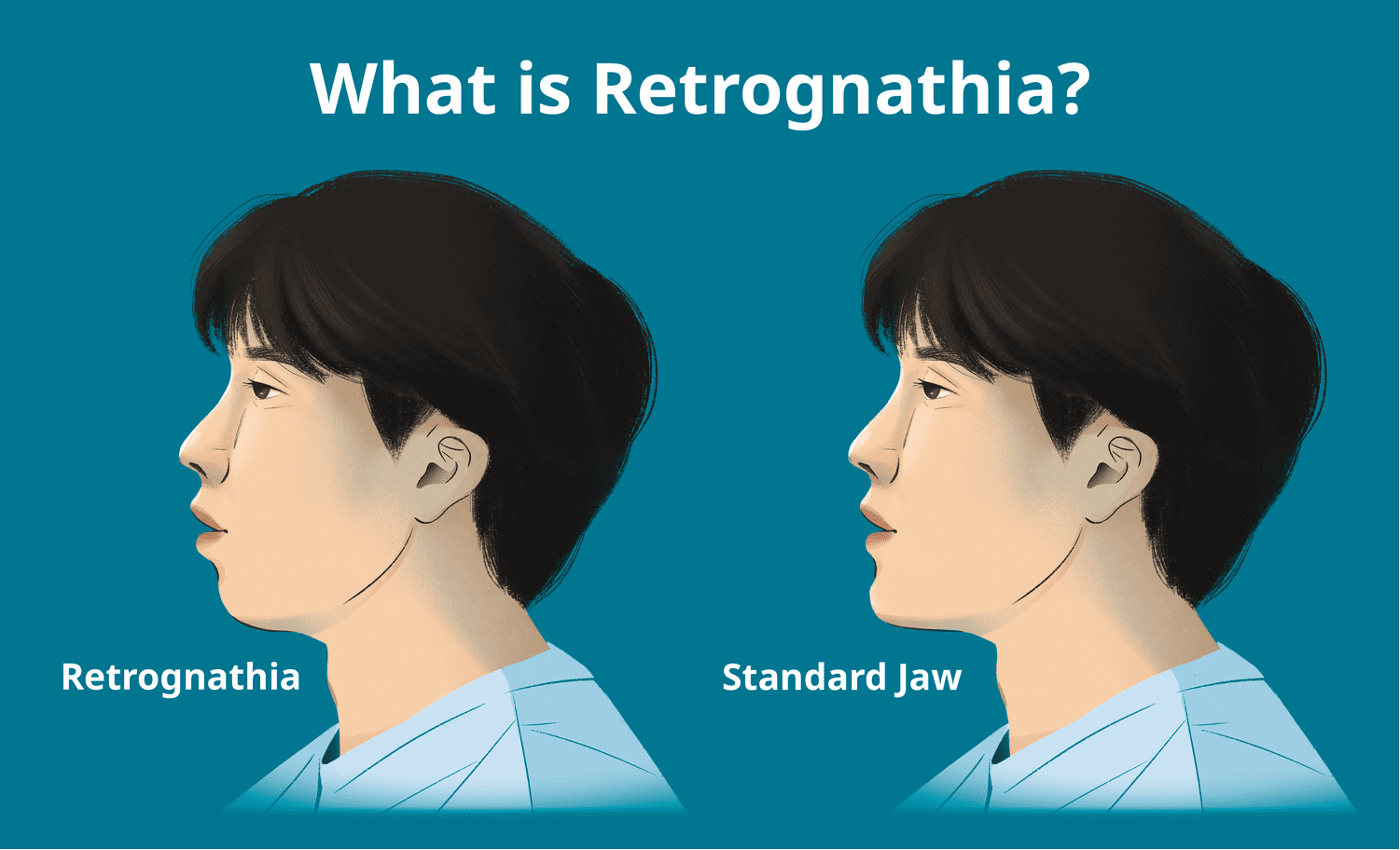 Two side‑profile illustrations: left labeled 'Retrognathia' and right labeled 'Standard Jaw' against a teal background, illustrating jaw alignment differences.