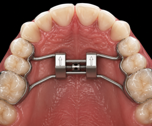 Top view of the upper dental arch showing a palatal expander attached to molars with a central screw for expanding the palate